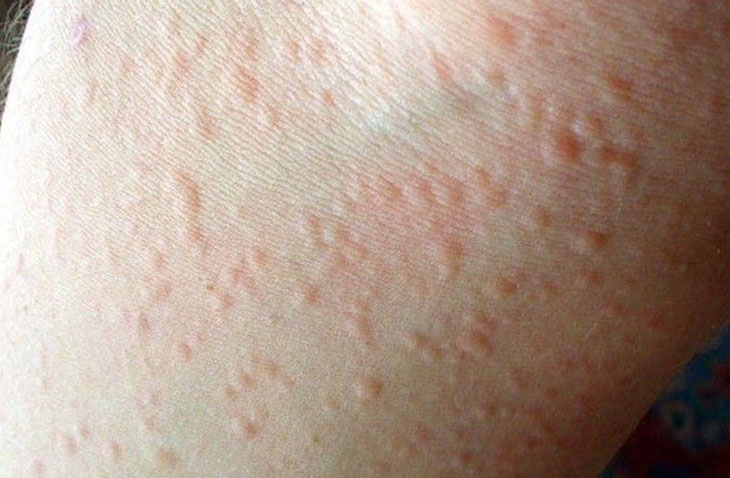 viêm da dị ứng do thời tiết