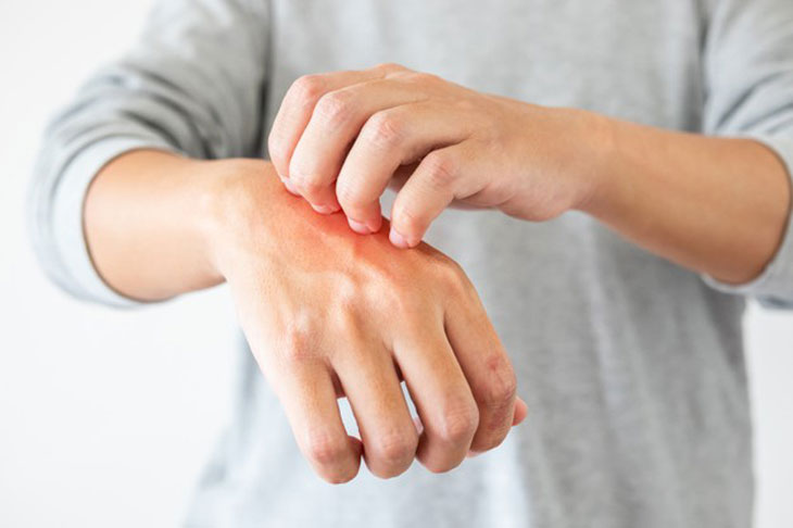 viêm da dị ứng