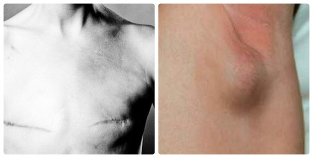 nổi hạch ở nách