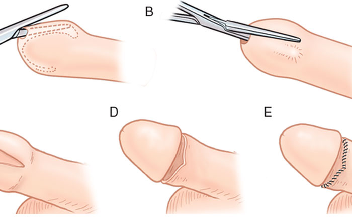 Phẫu thuật cắt bao quy đầu