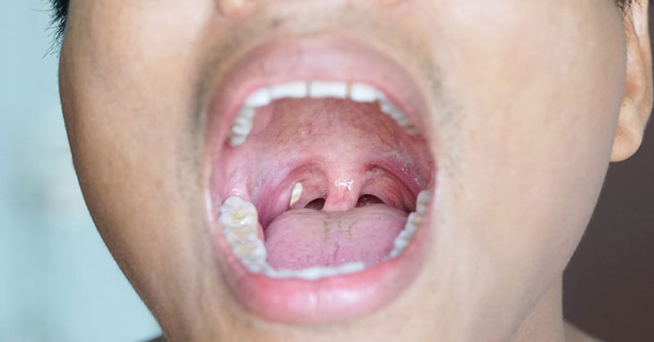 Amidan có hạt màu trắng