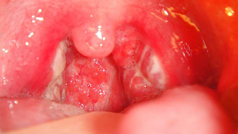 dau-rat-co-hong-kho-nuot