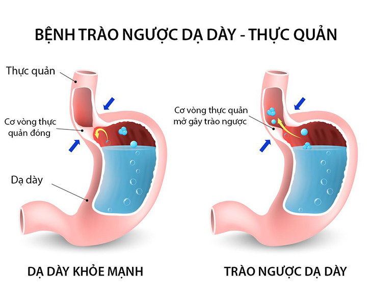 thuốc điều trị trào ngược dạ dày thực quản