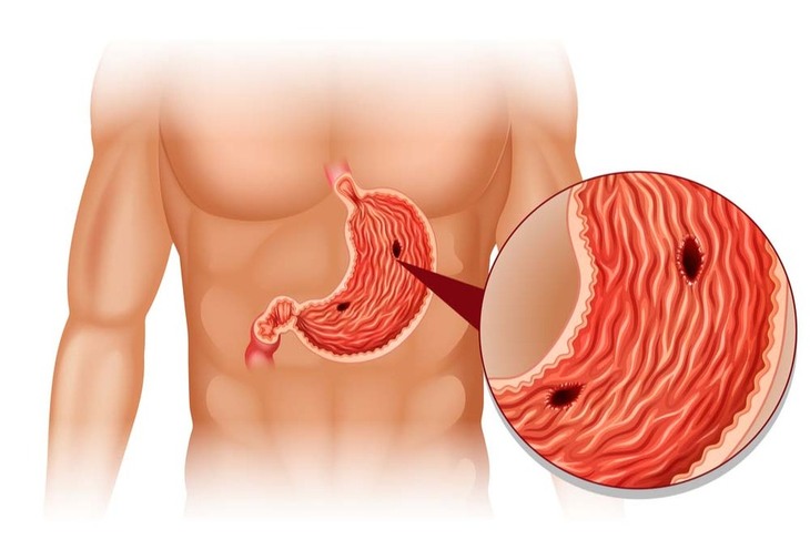 ợ chua buồn nôn bệnh gì
