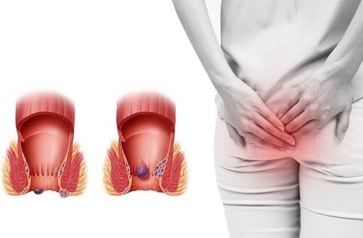 đi ngoài bị nóng rát hậu môn