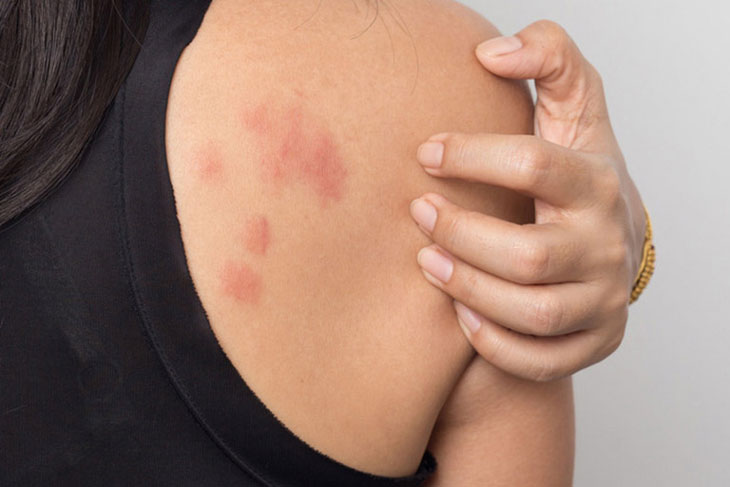 Phát ban nổi mề đay là di chứng hậu Covid nhiều người gặp phải
