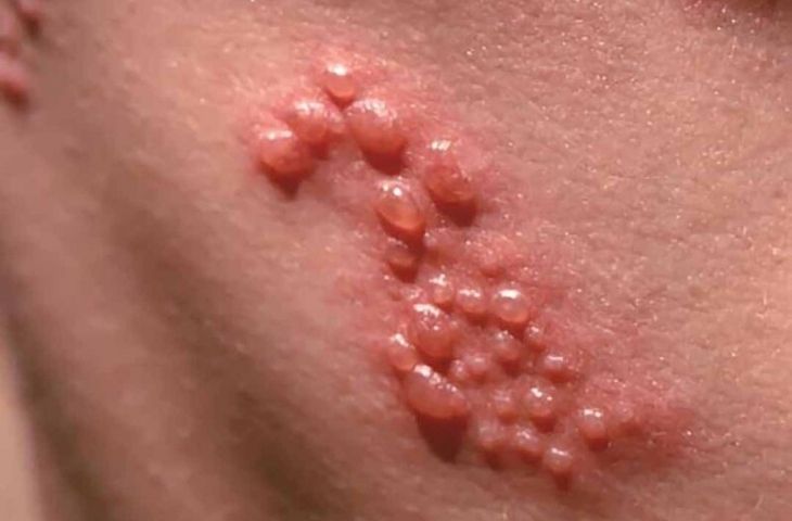 chăm sóc trẻ bị thủy đậu