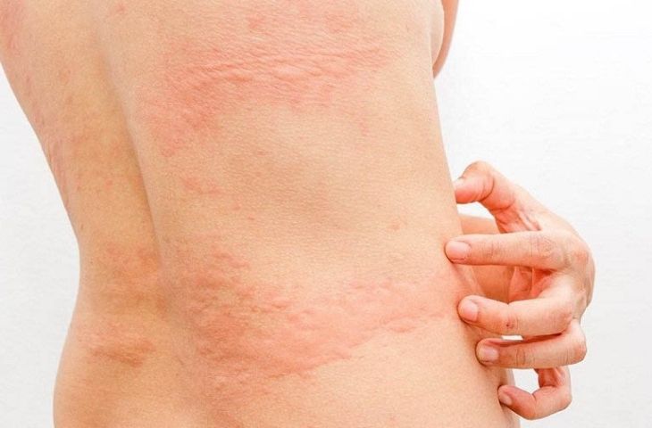 dấu hiệu nổi mề đay ở trẻ