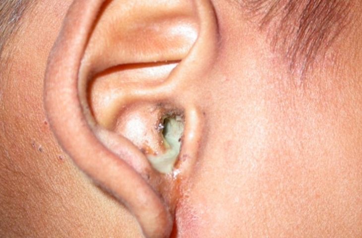 Ngứa lỗ tai trái, phải nguyên nhân do đâu? Cách xử trí tốt nhất