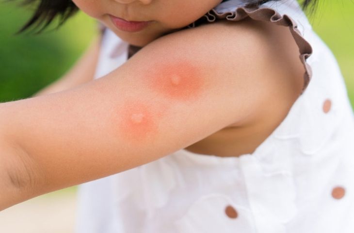nguyên nhân nổi mề đay ở trẻ