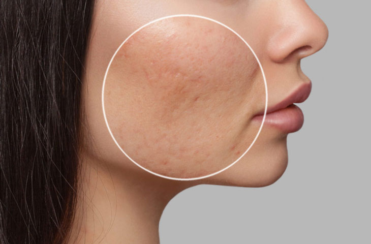 sẹo lõm thủy đậu