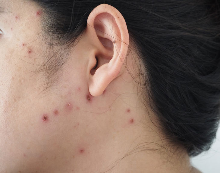 sẹo lõm thủy đậu