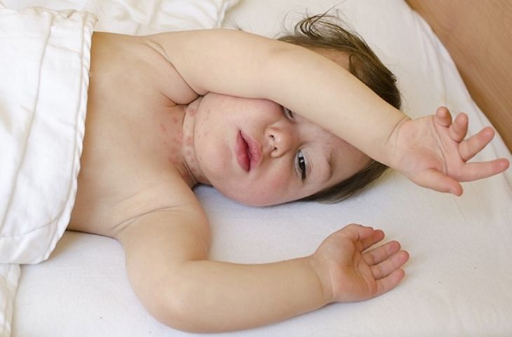 rôm sảy ở cổ