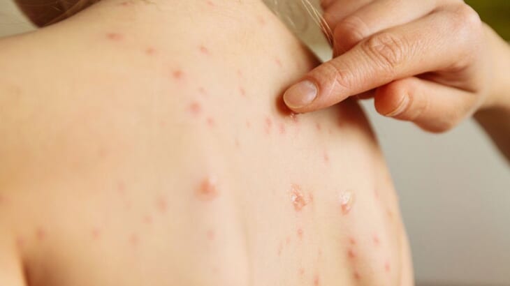 Phân biệt bệnh sởi Đức và bệnh sởi thông thường