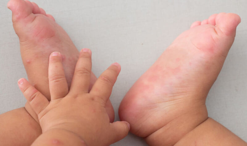 Hướng dẫn chăm sóc trẻ bị tay chân miệng đúng cách tại nhà để nhanh khỏi bệnh