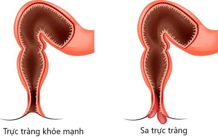 hậu quả của táo bón ở trẻ em