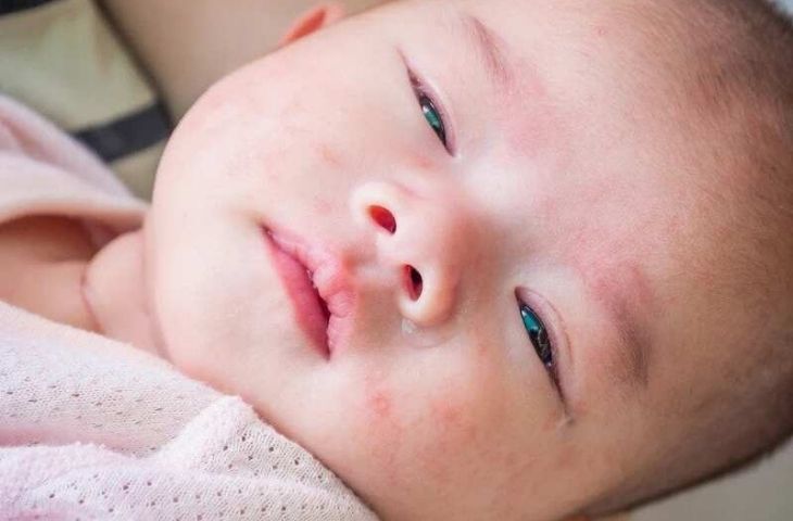 trẻ bị nổi mề đay có nguy hiểm không