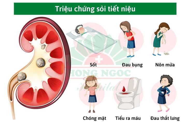 triệu chứng sỏi tiết niệu