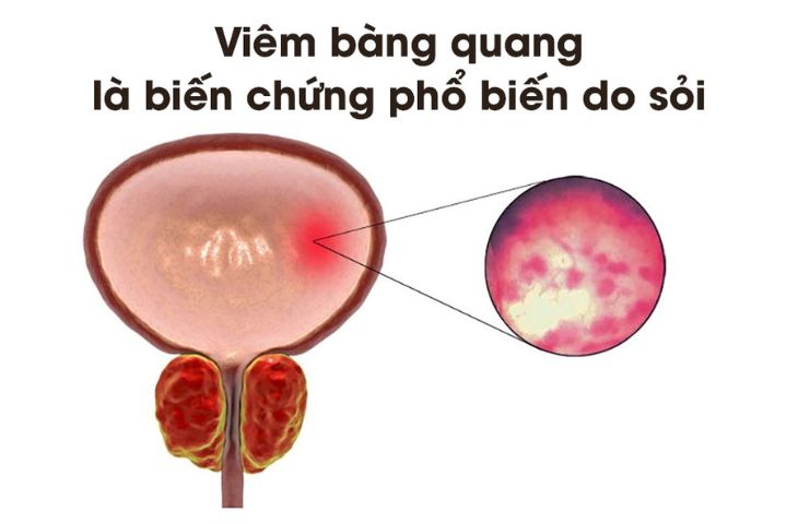nguyên nhân gây sỏi bàng quang