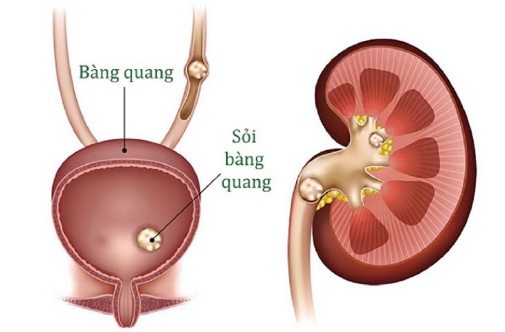 nguyên nhân gây sỏi bàng quang