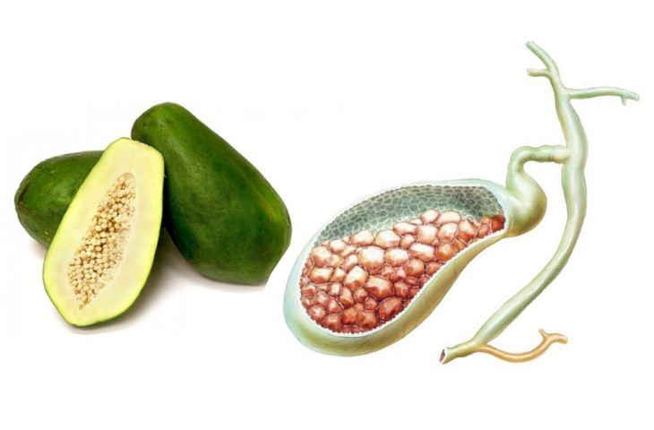 sỏi bàng quang có nguy hiểm không