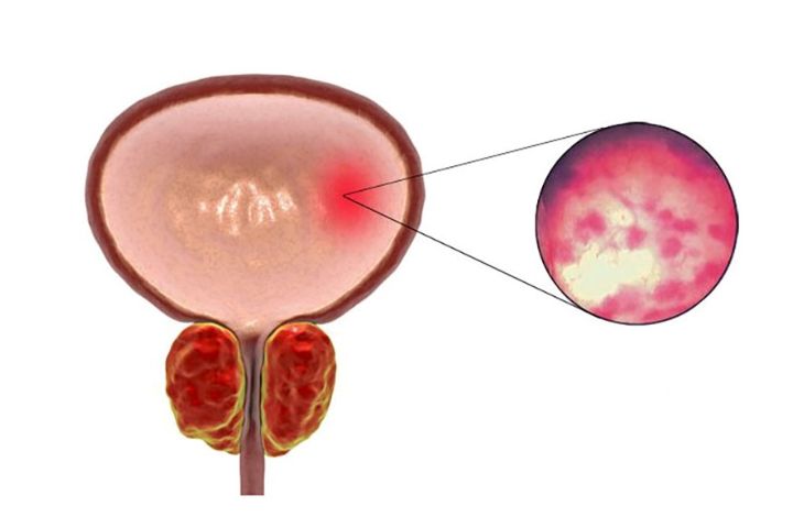 sỏi bàng quang có nguy hiểm không