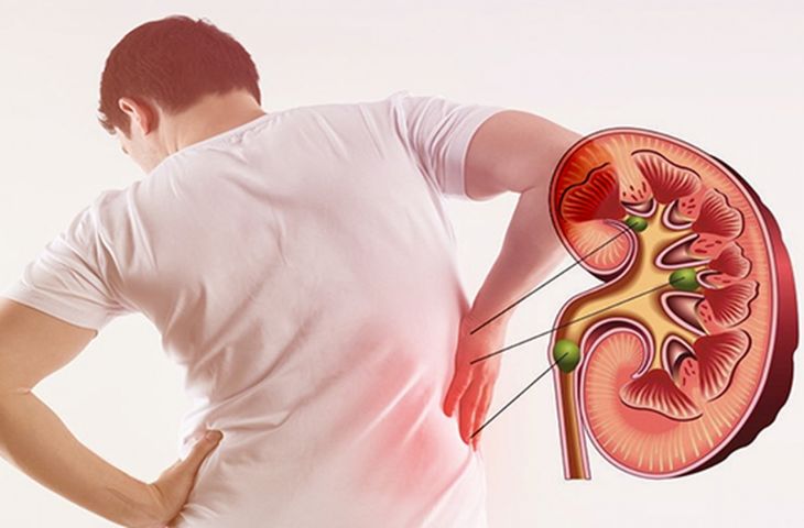 sỏi thận rơi xuống bàng quang
