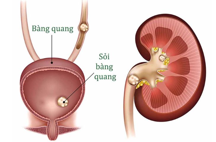 Triệu chứng sỏi bàng quang