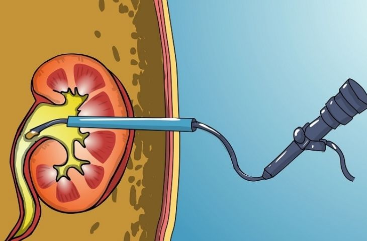 Chi phí tán sỏi thận qua da
