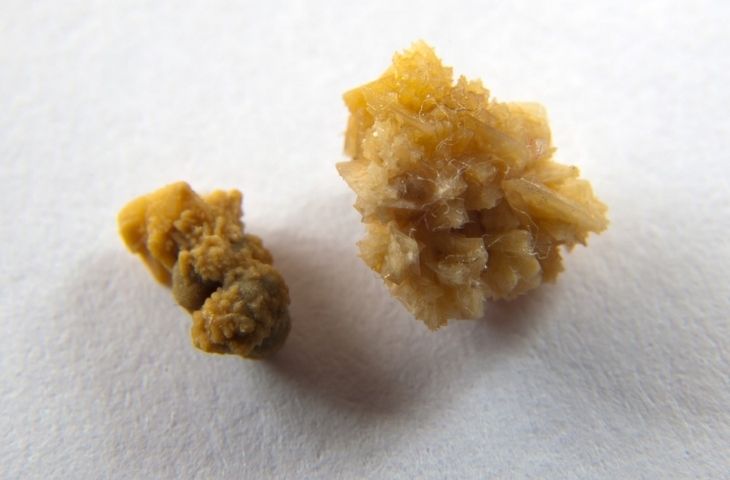 sỏi bàng quang 5mm