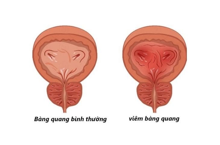 sỏi bàng quang 5mm