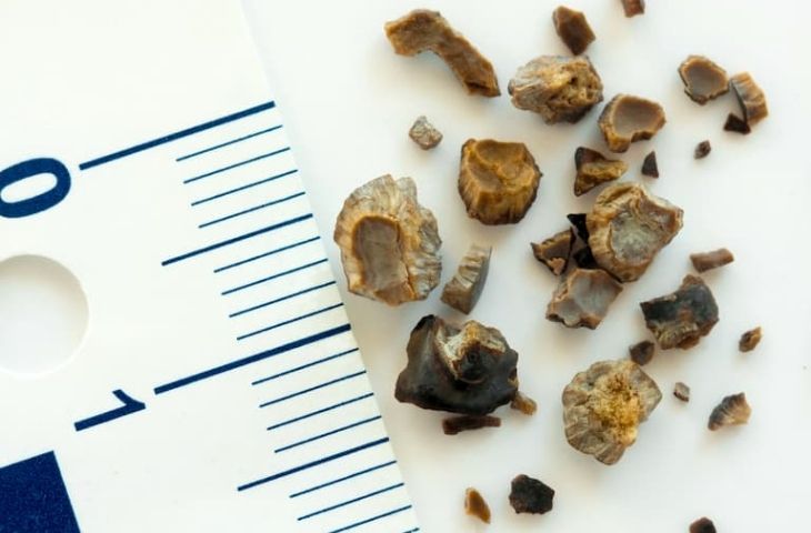 sỏi bàng quang 5mm