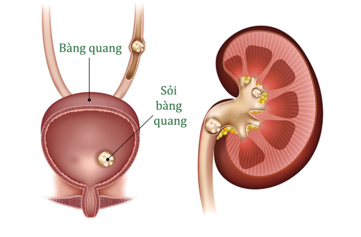 tán sỏi bàng quang