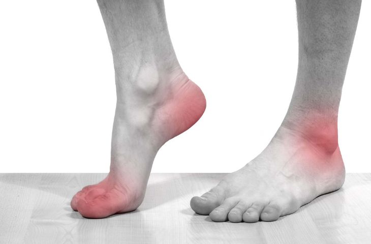 Bệnh gút cấp tính gây đau trong thời gian ngắn
