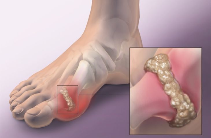Bệnh gút là một dạng viêm cấp phổ biến