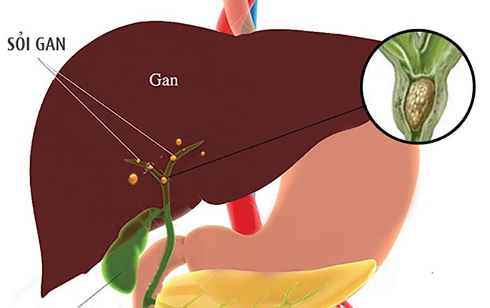 Sỏi gan nên ăn gì