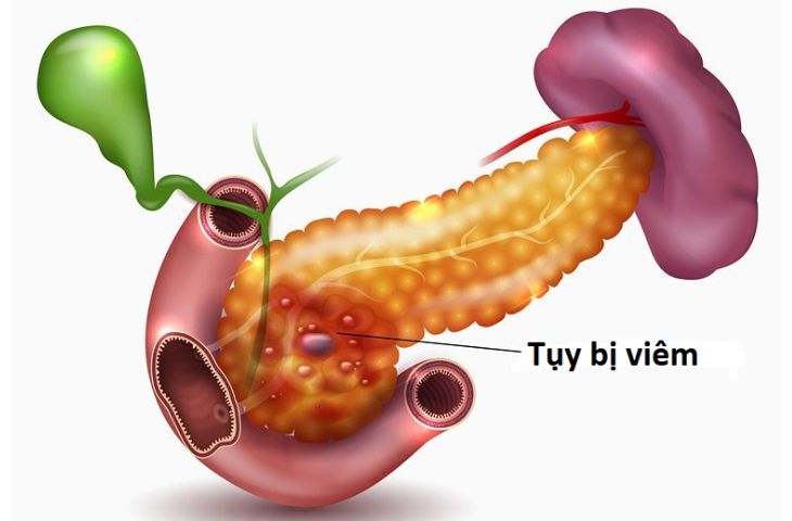 sỏi mật gây viêm tụy cấp