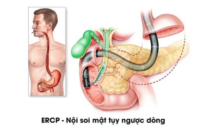 sỏi tụy có nguy hiểm không
