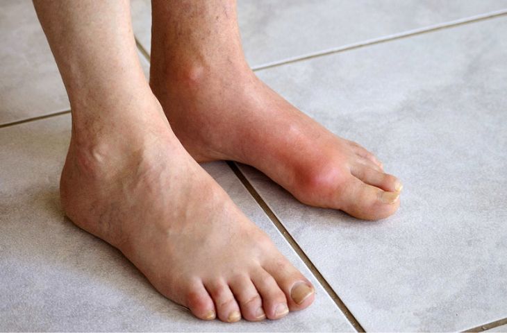 Các triệu chứng bệnh gút khiến cho người bệnh khó khăn trong di chuyển và vận động
