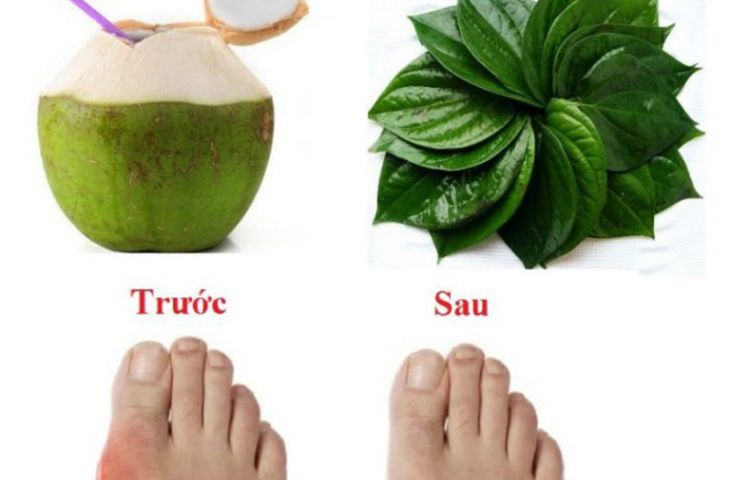 Chữa bệnh gút cấp bằng lá trầu không