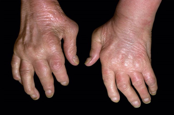 Biến chứng bệnh gút