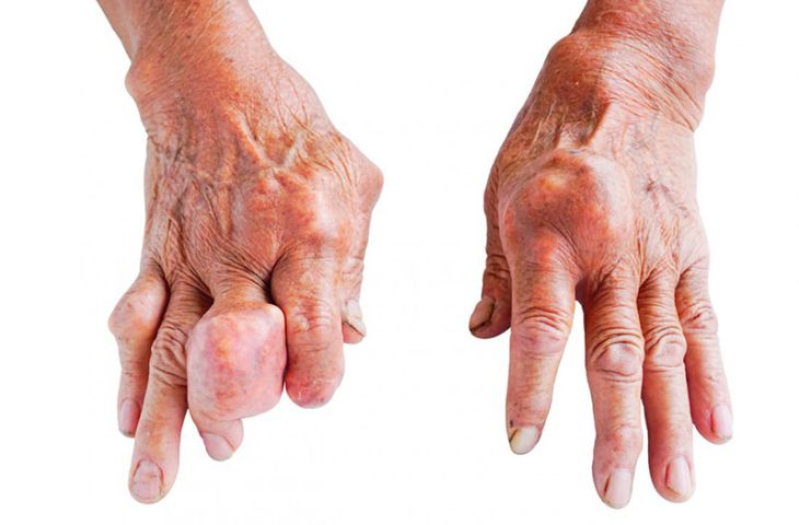 Điều trị gút