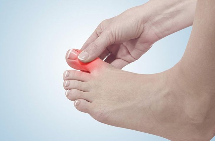 Gút cấp tính gây ra những cơn đau ở ngón chân cái