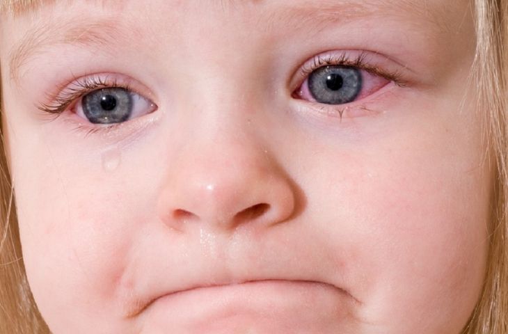 Viêm kết mạc ở người nhiễm virus Adeno