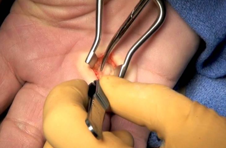 Phẫu thuật ngón tay lò xơ