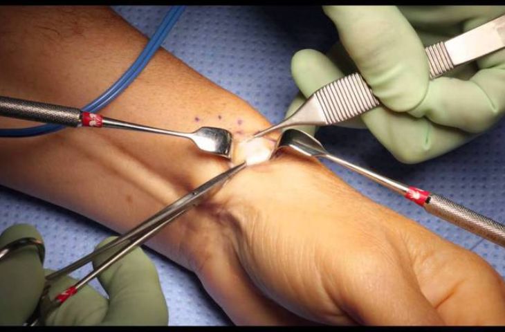 hội chứng de-quervain