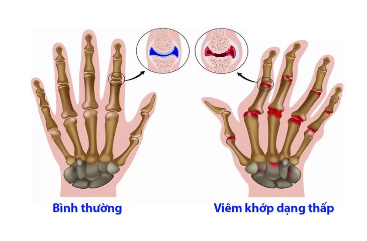 khám viêm khớp dạng thấp