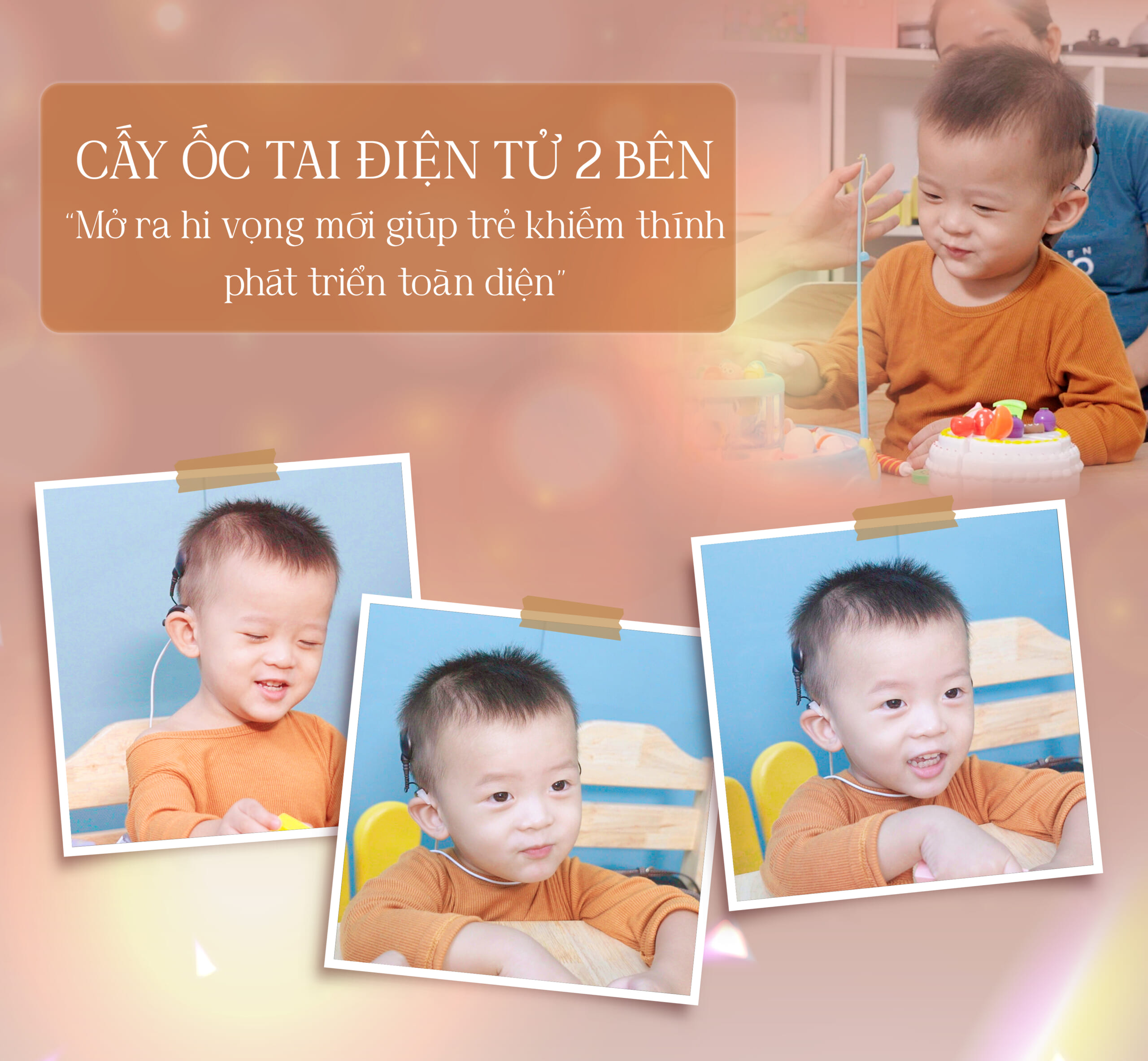 1 tháng sau cấy ốc tai bé khỏe mạnh