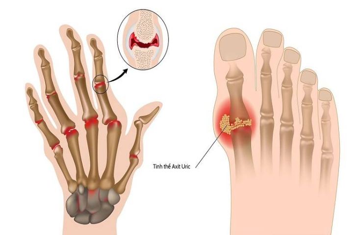 nguyên nhân viêm khớp dạng thấp