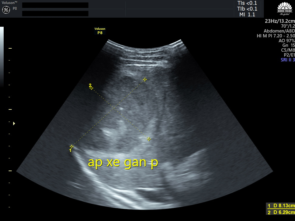 Khối áp-xe lớn với kích thước 8.13x6.29cm, nằm sát bao gan và màng phổi